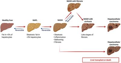 Association between serum ferritin level and the various stages of non-alcoholic fatty liver disease: A systematic review